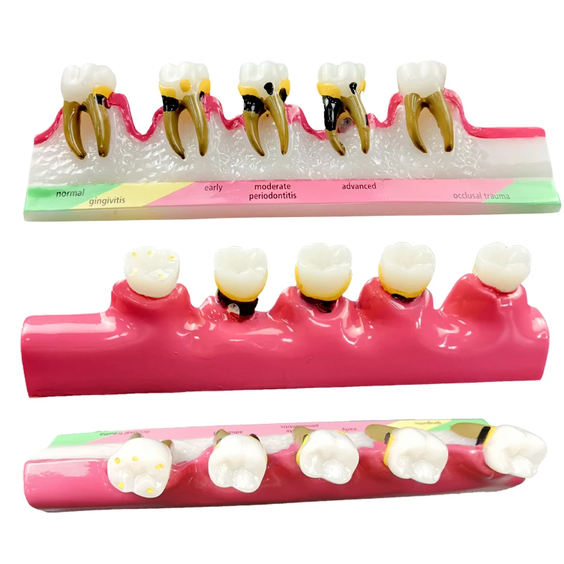 Dental, Doença Periodontal, Classificar Demo Dentes Modelo 5 Fase três-Dimensional Proporcional Ampliação de Design para Dentista